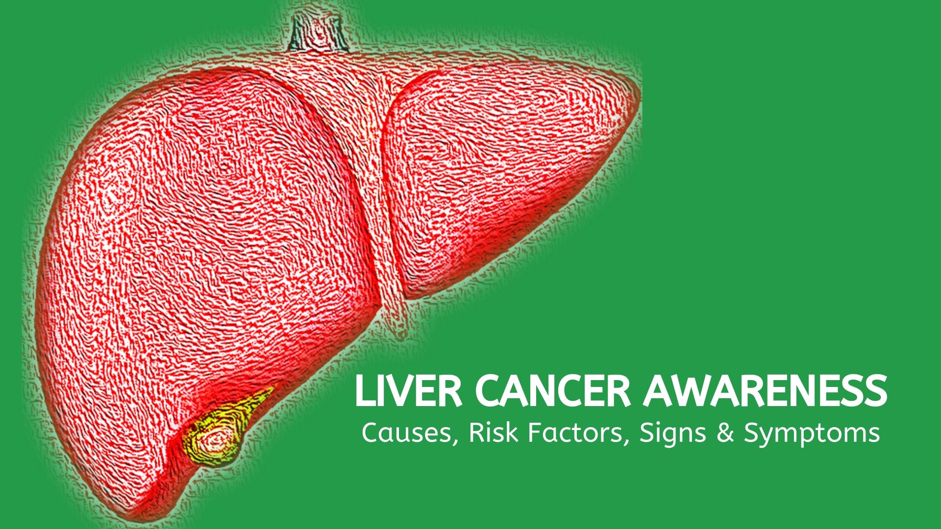 You are currently viewing Liver Cancer Awareness: Causes, Signs & Symptoms
